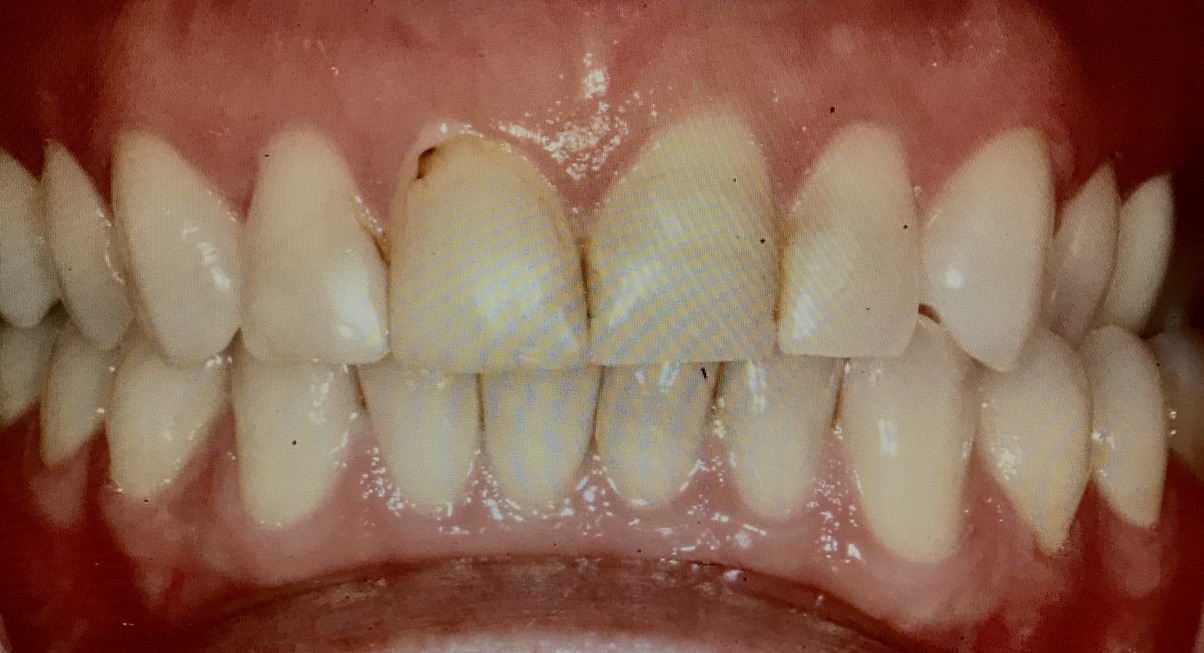 Veneers before