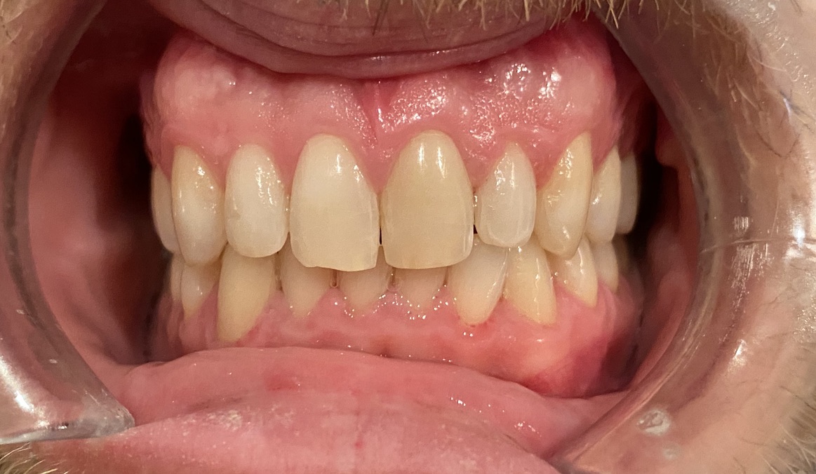Internal Bleaching before