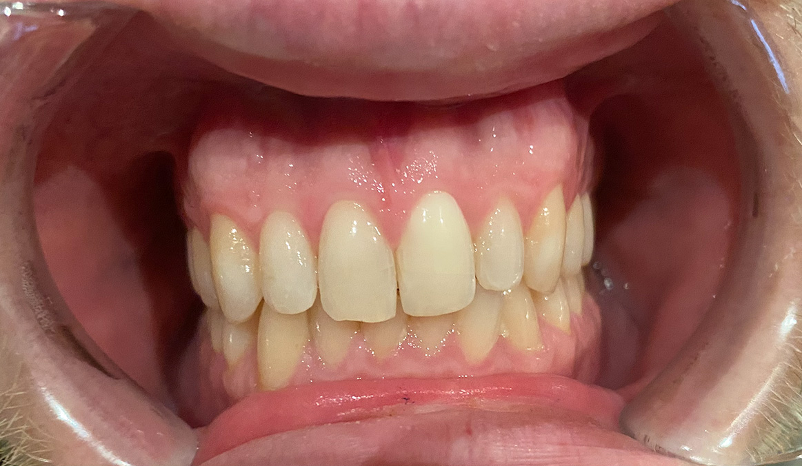 Internal Bleaching after