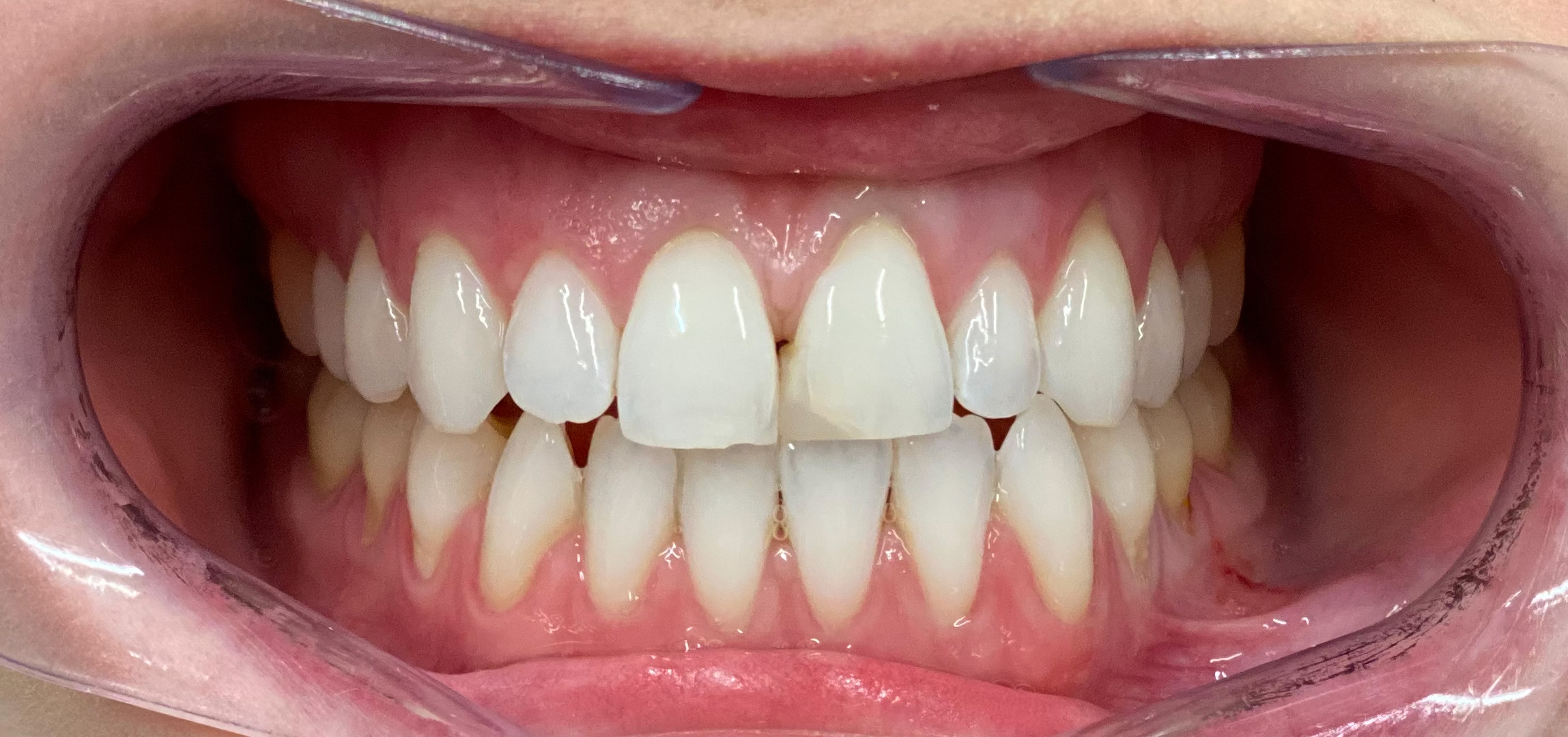 Composite bonding before