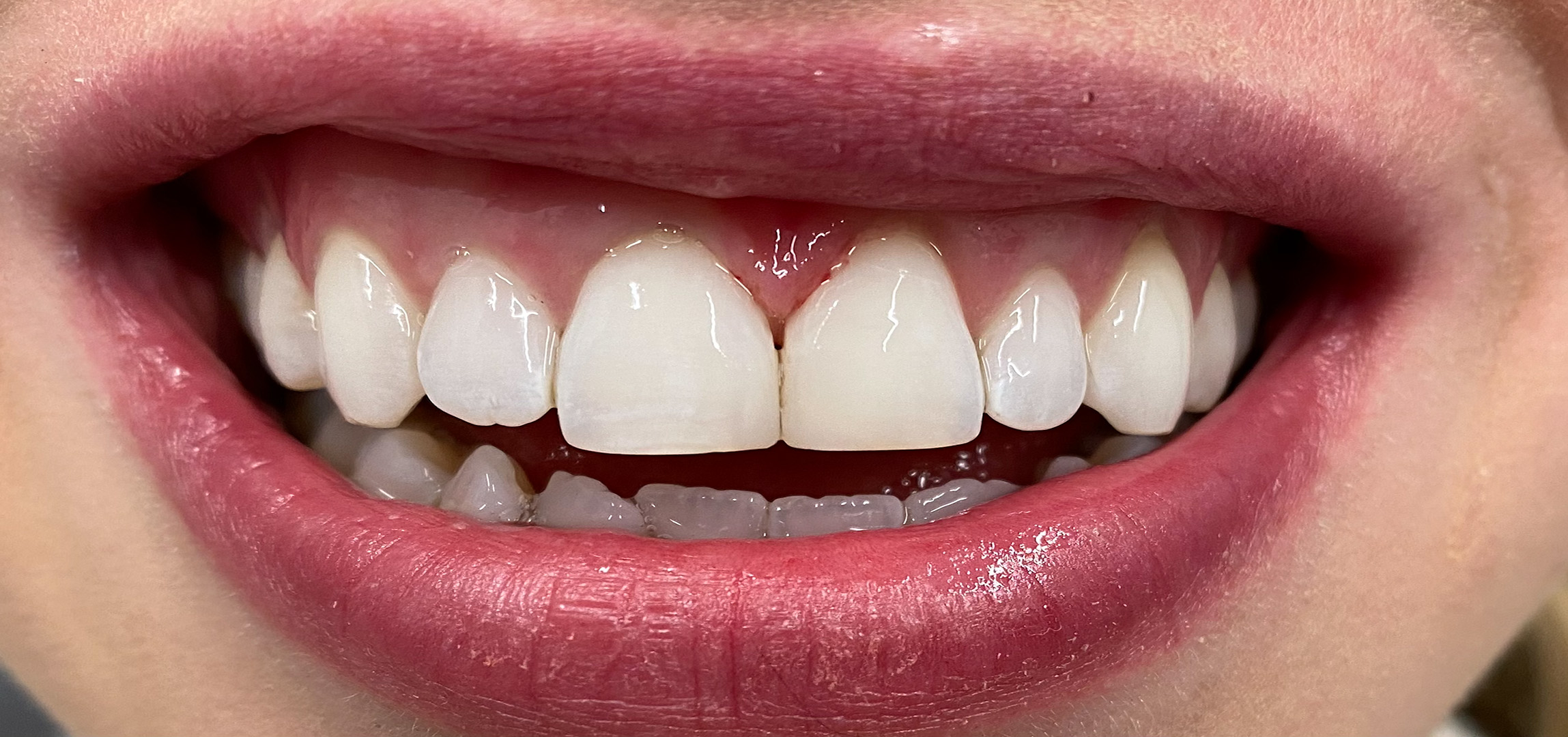 Composite bonding after