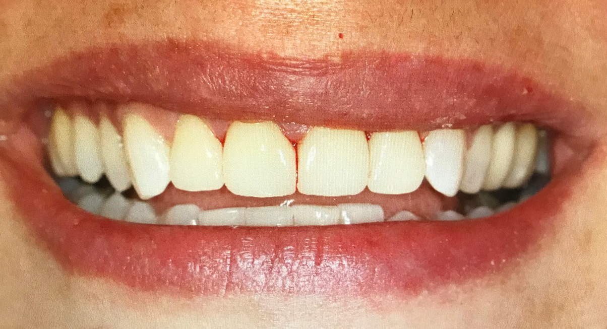 Veneers after