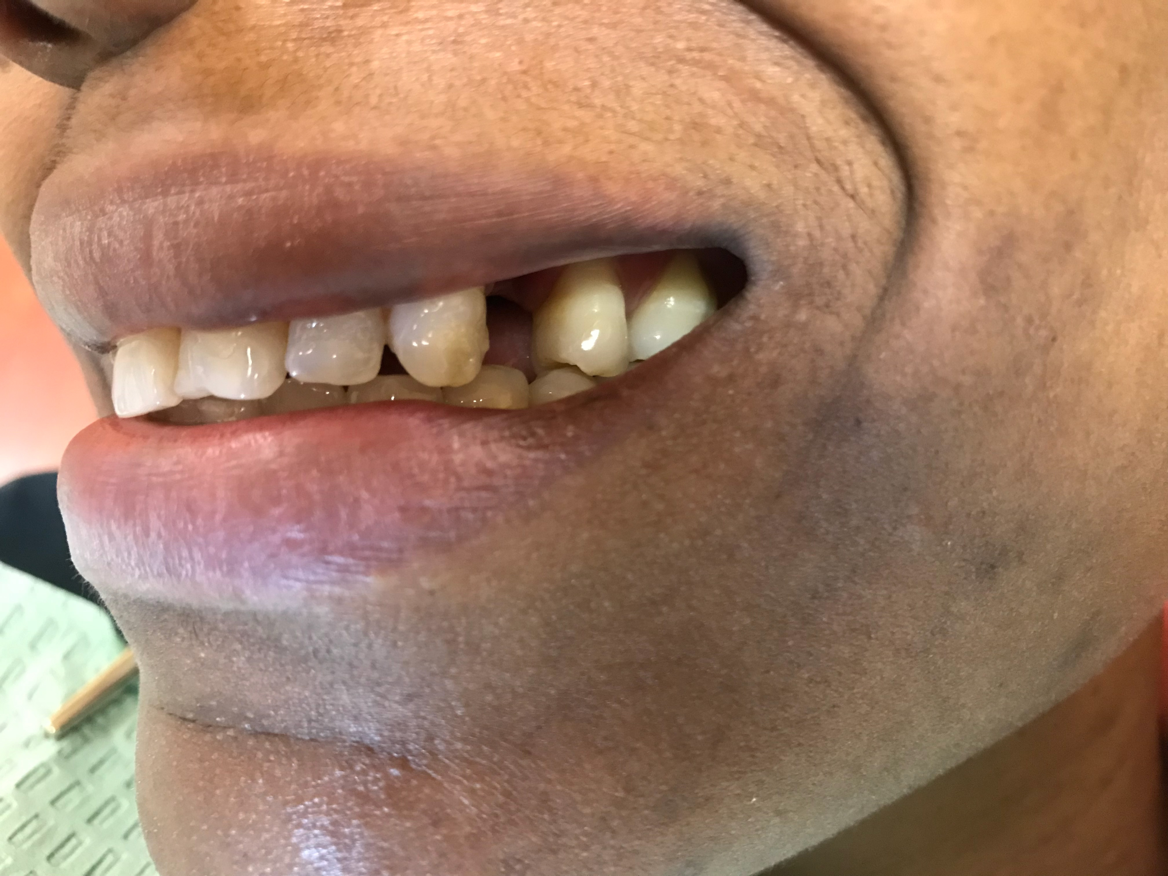 Dental Implant before