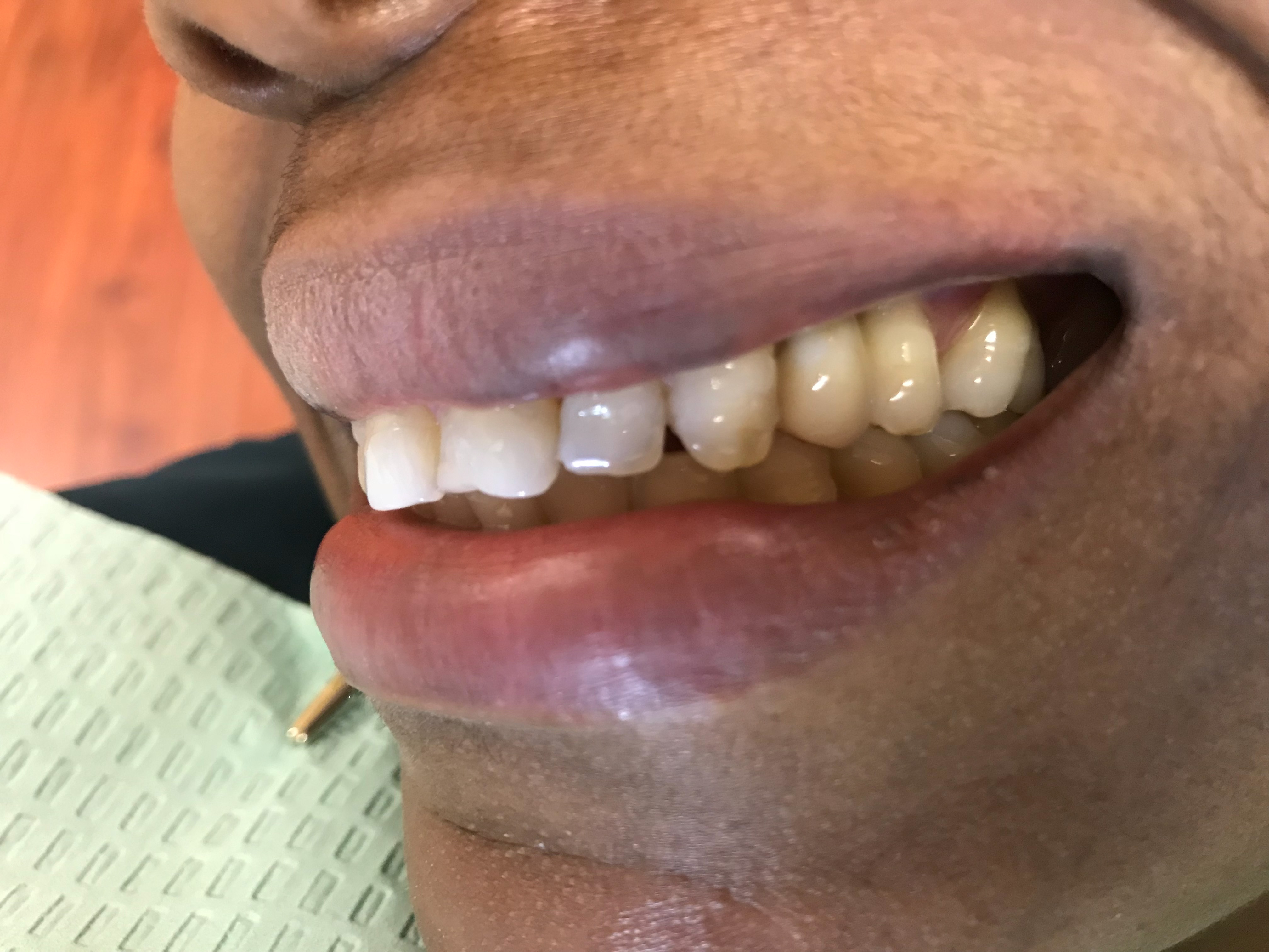 Dental Implant after