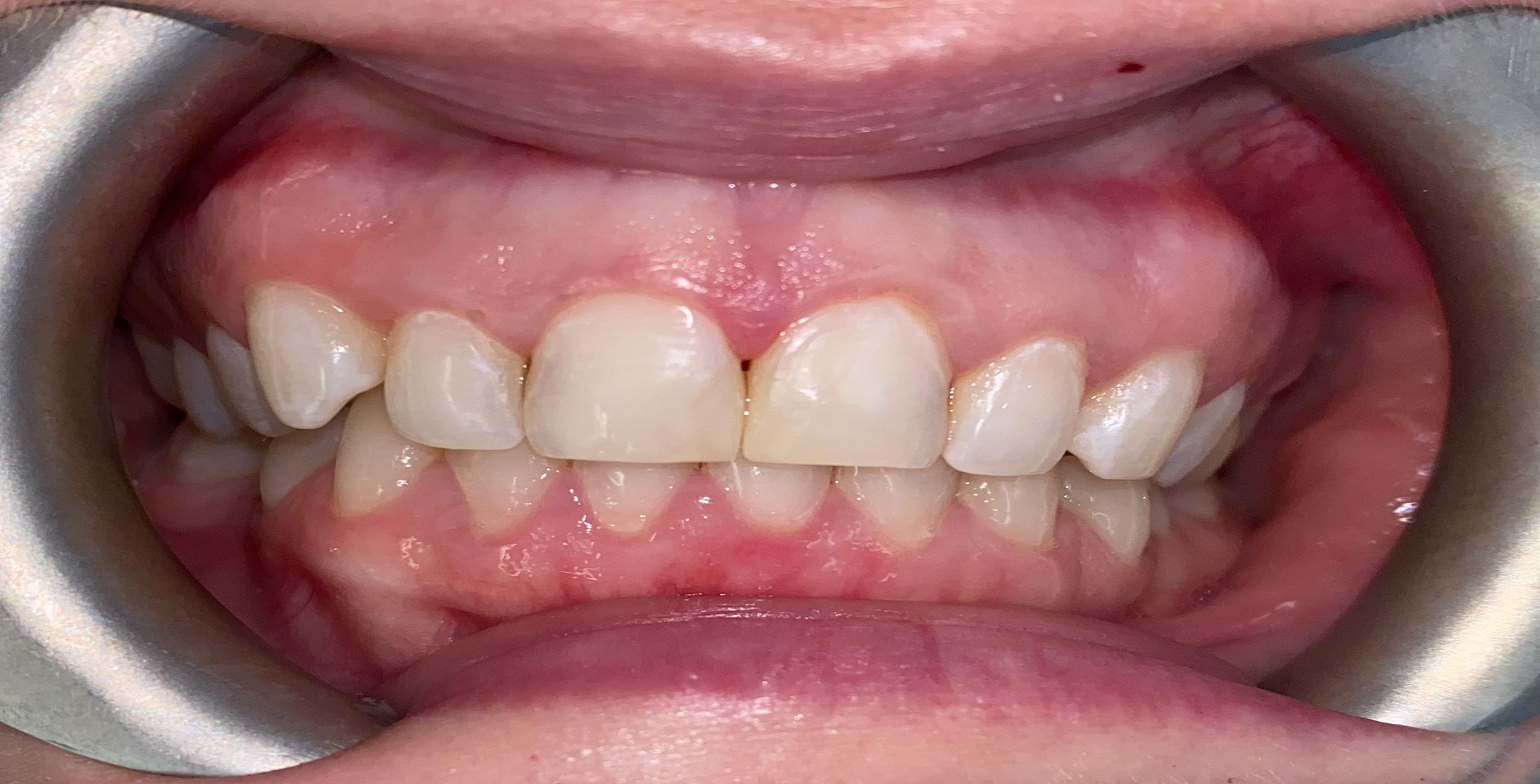 Composite Bonding after