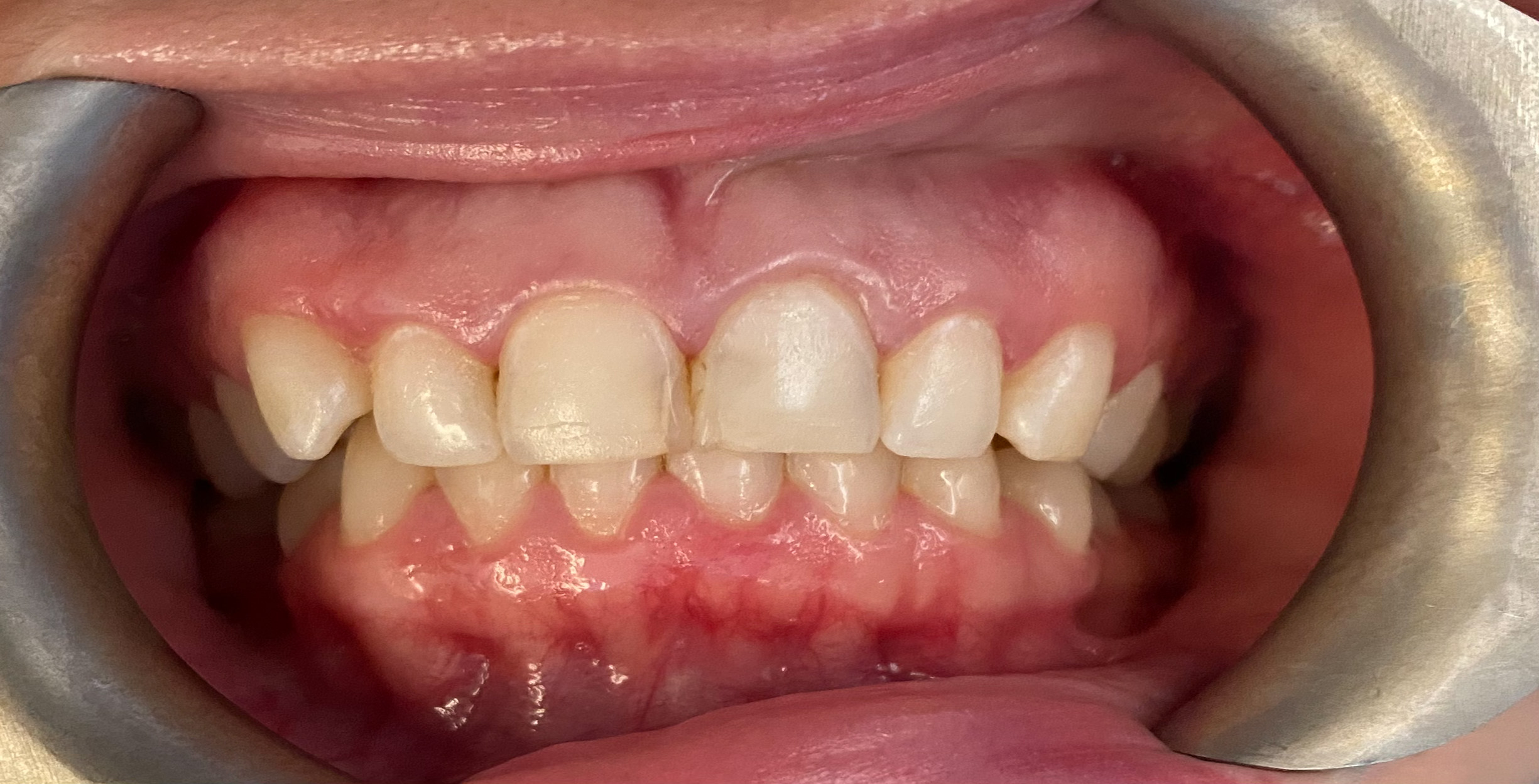 Composite Bonding before