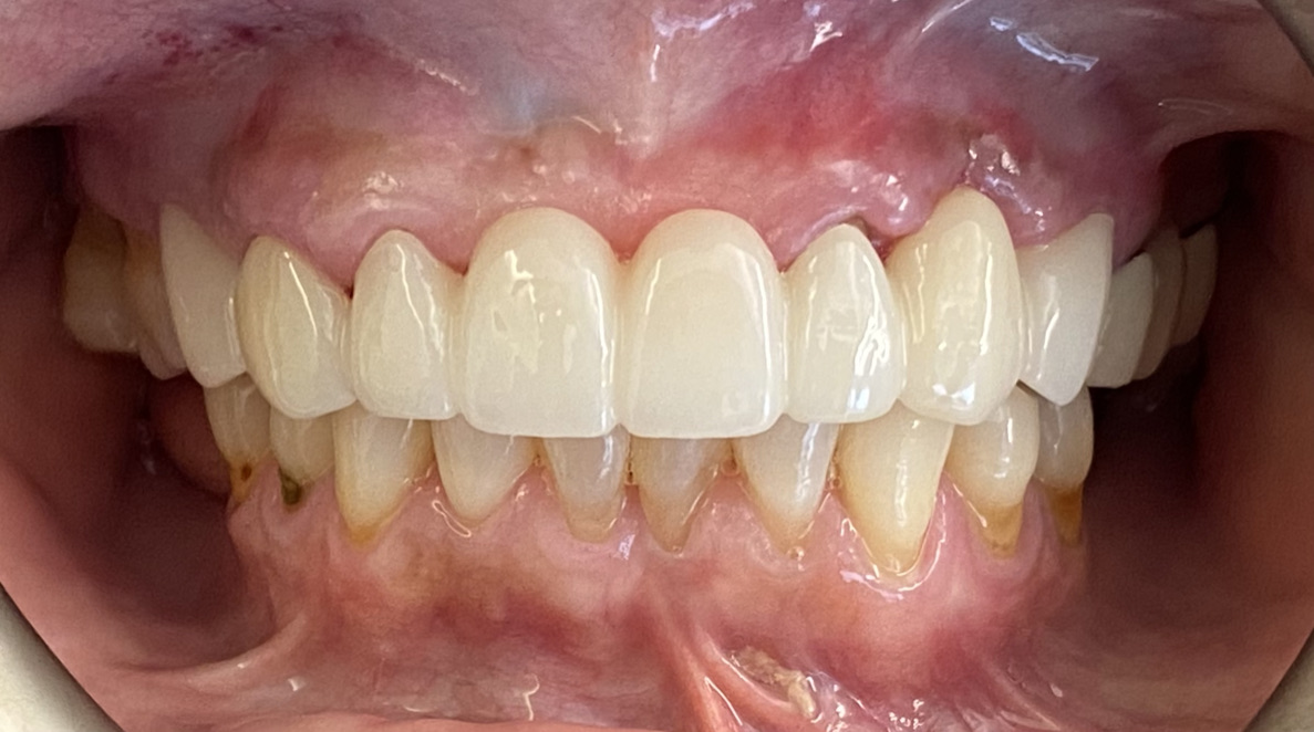 Dental Bridge after