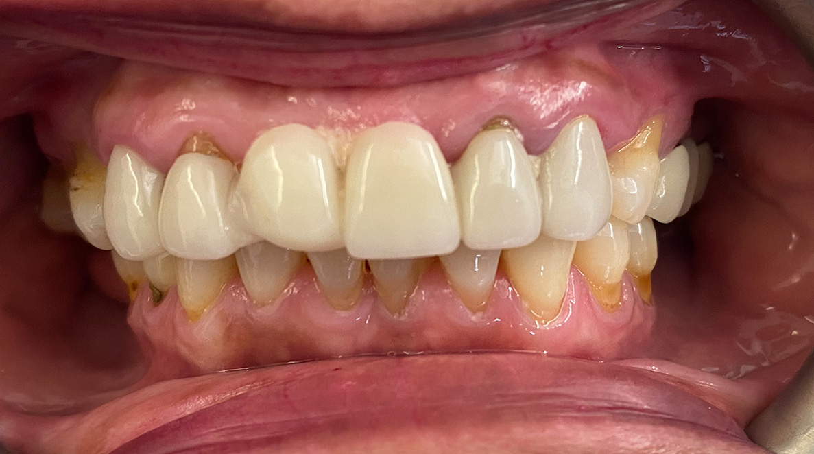 Dental Bridge before