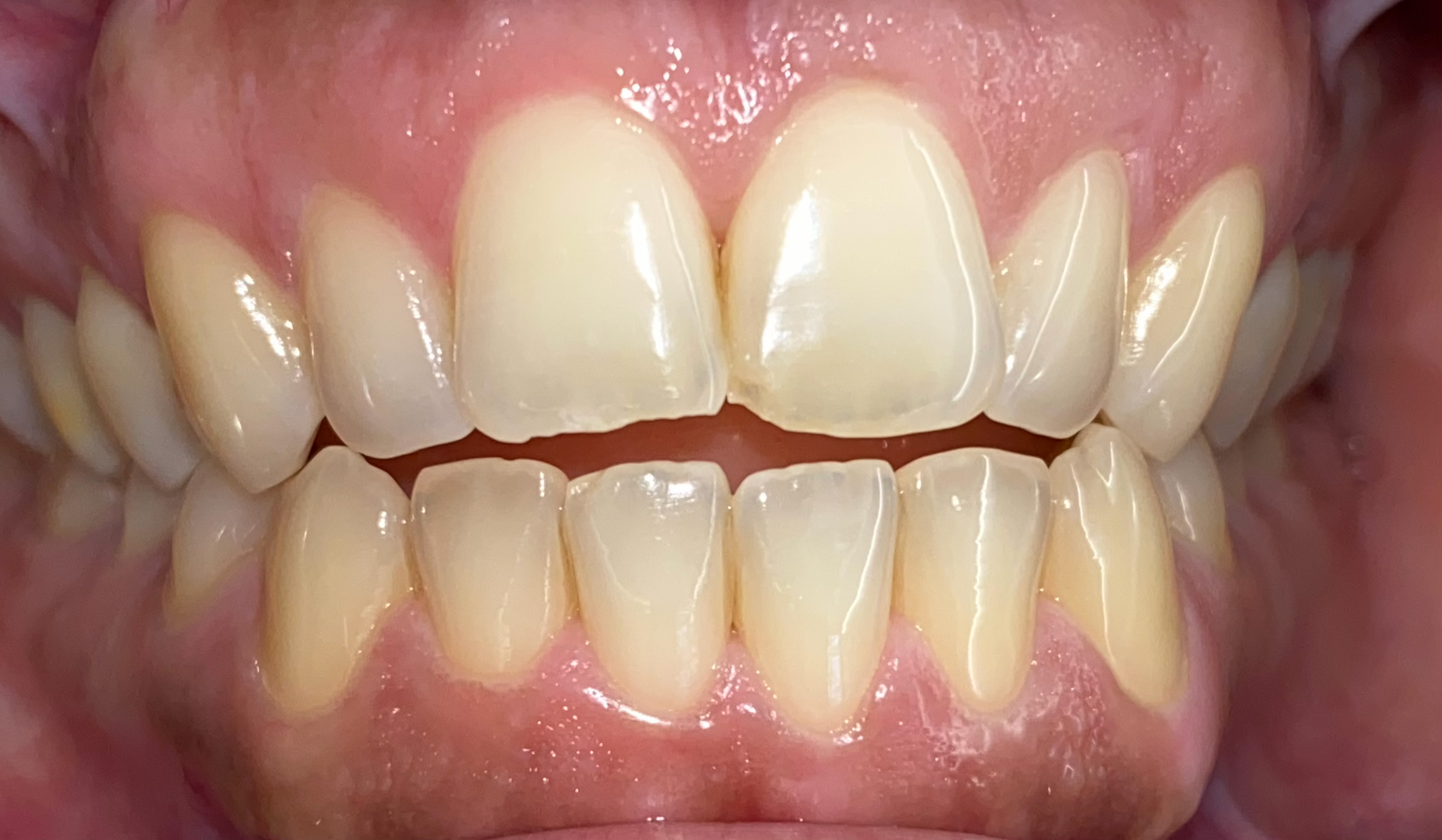 Anterior Bondings before