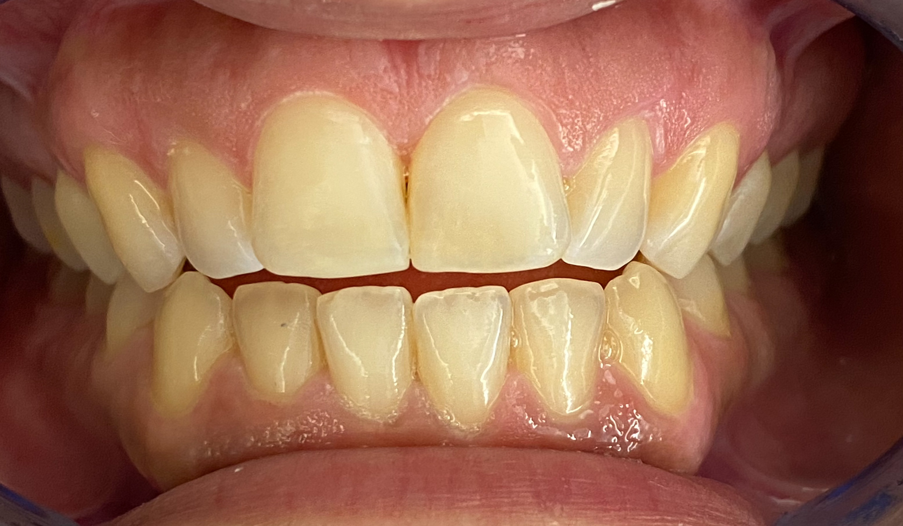 Anterior Bondings after