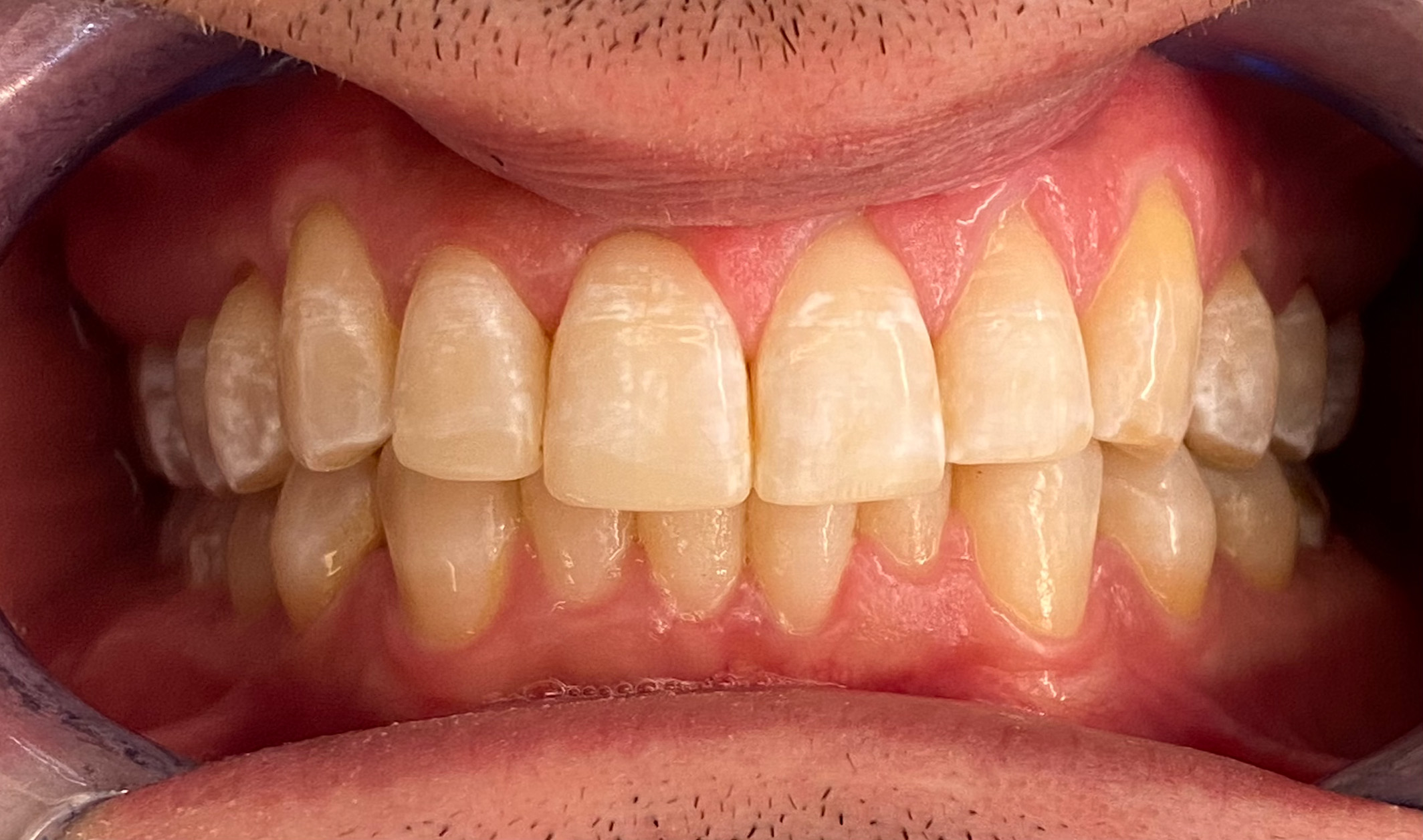 Anterior Bondings after