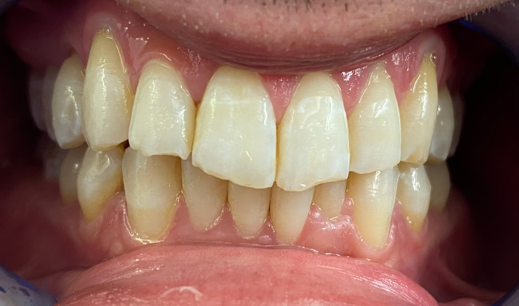 Anterior Bondings before