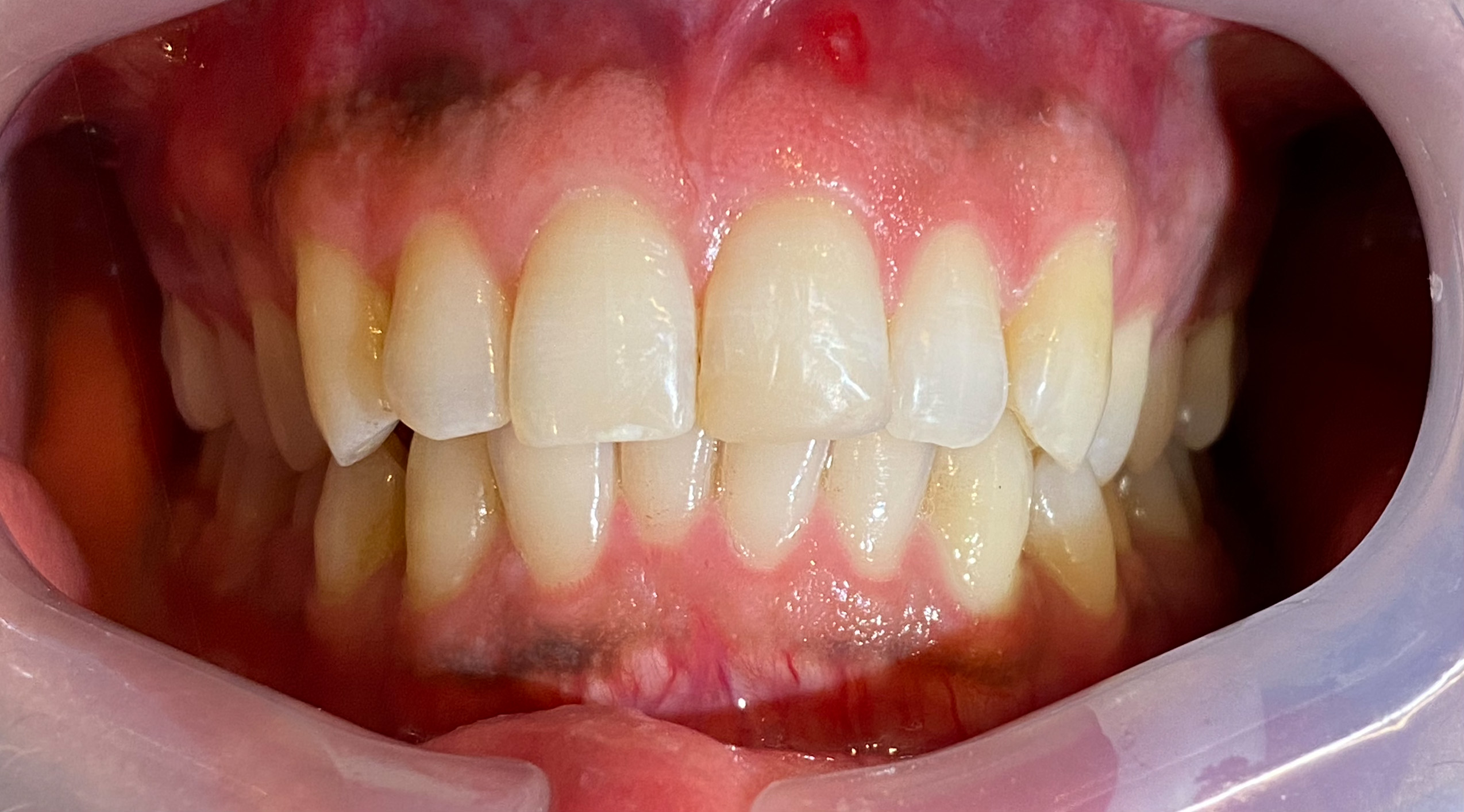Composite Bonding after