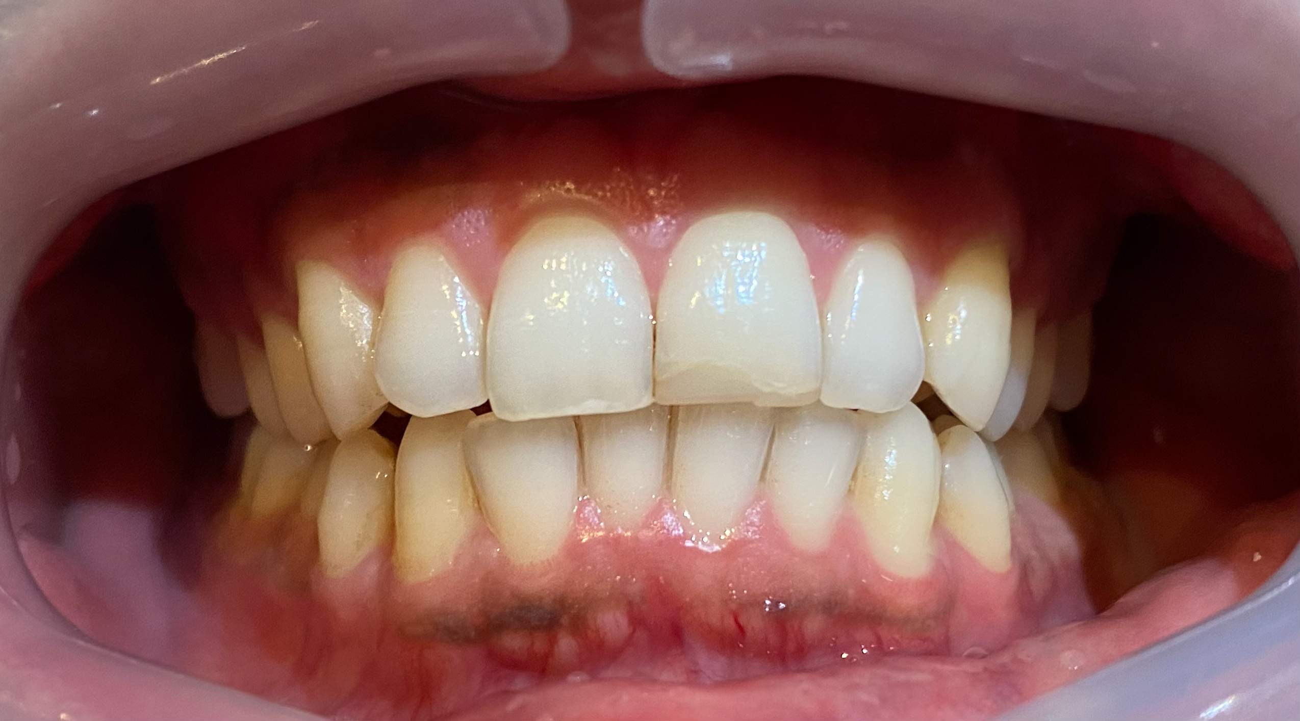 Composite Bonding before