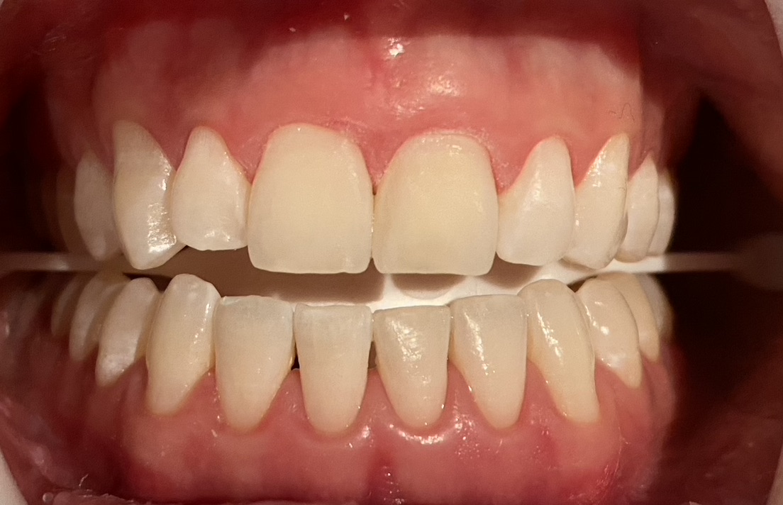 ICON white spot treatment after