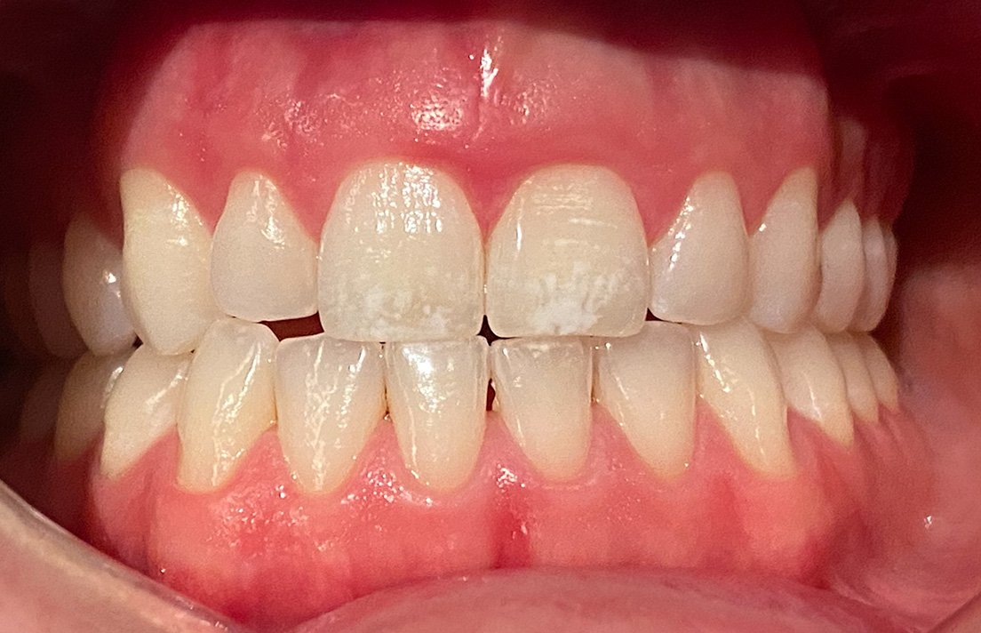 ICON white spot treatment before