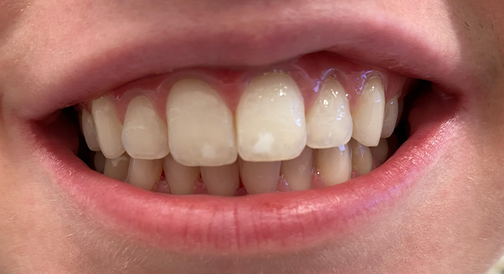 ICON white spot treatment before