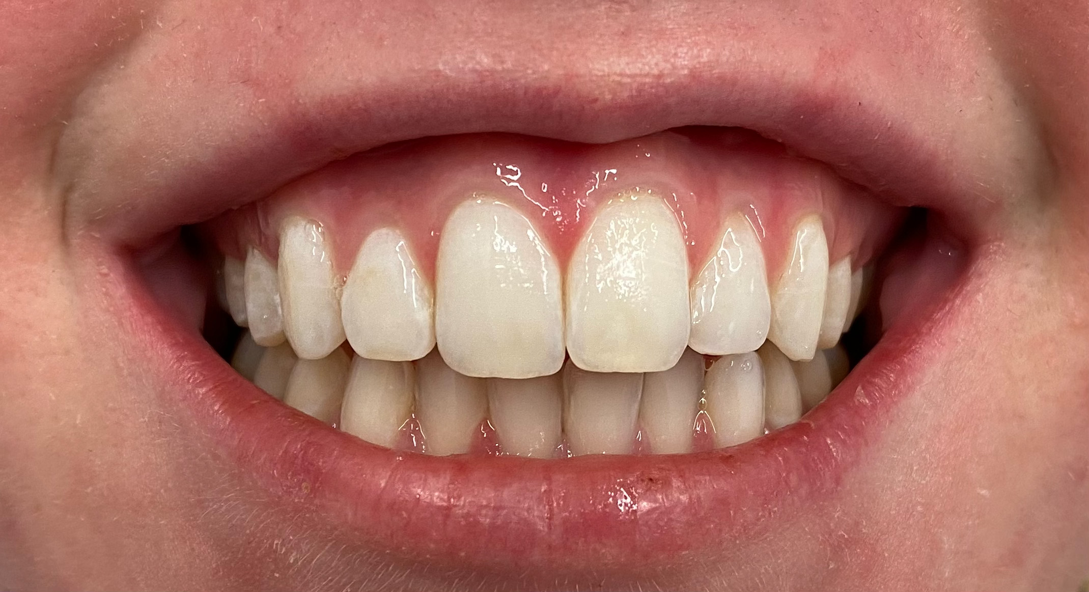 ICON white spot treatment after