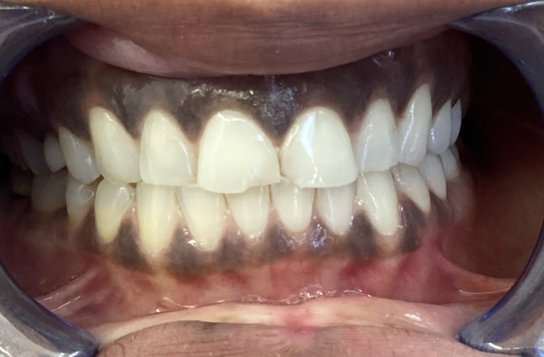 Veneers before