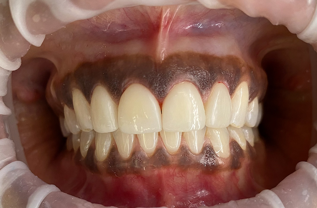 Veneers after