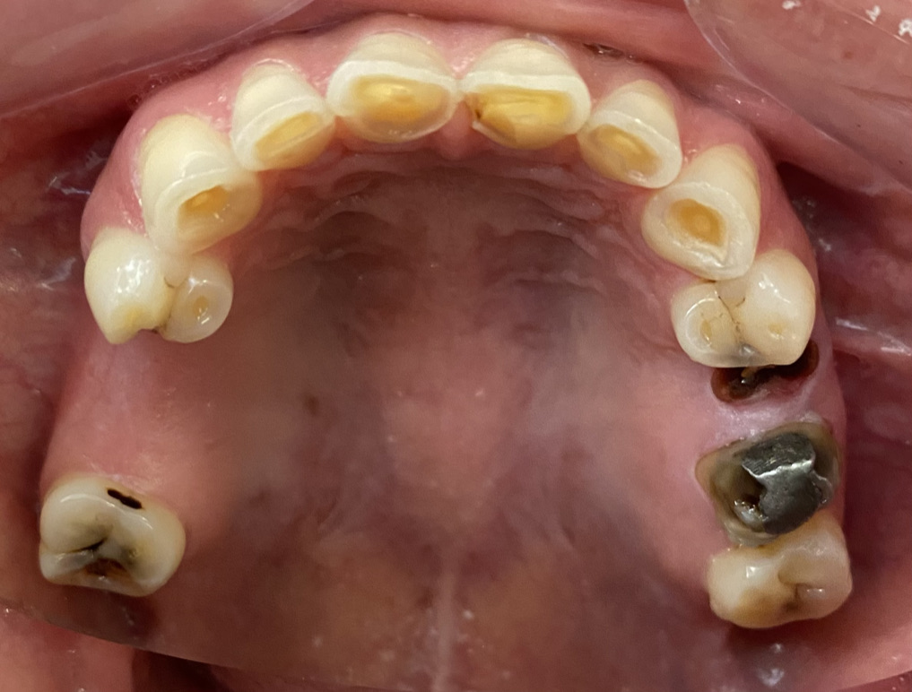 Full mouth reconstruction before