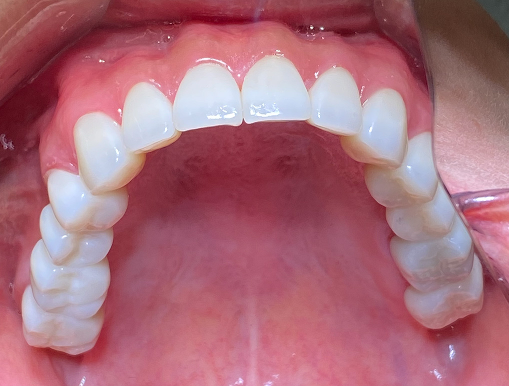 Full mouth reconstruction after