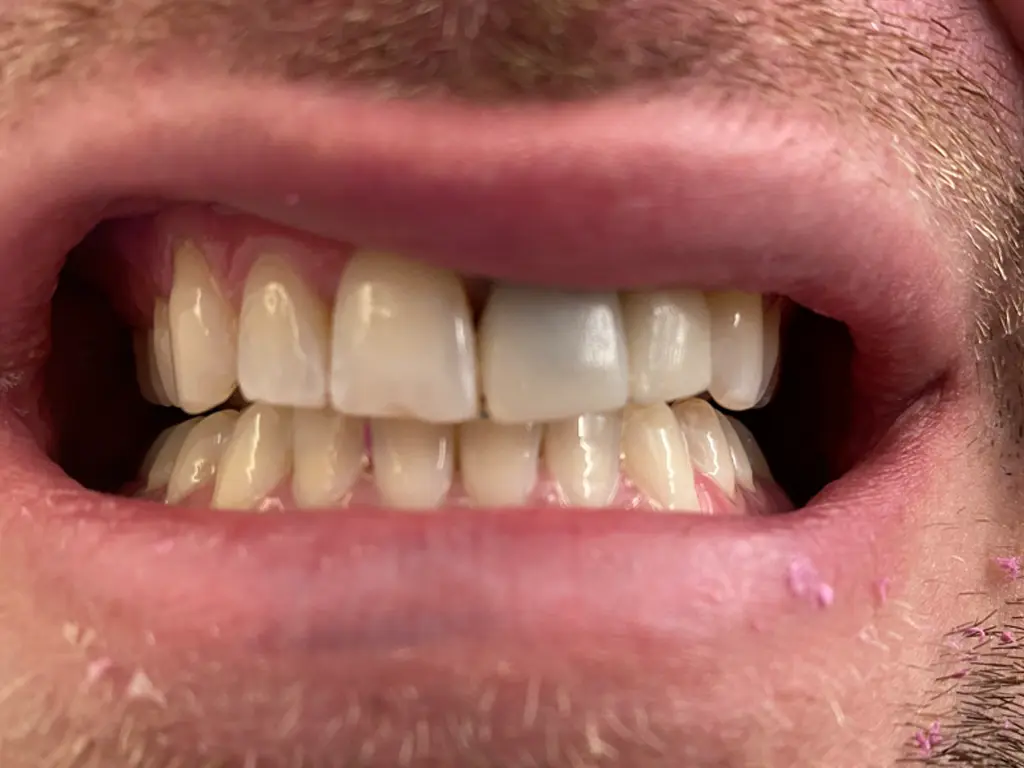 Ceramic Crown before