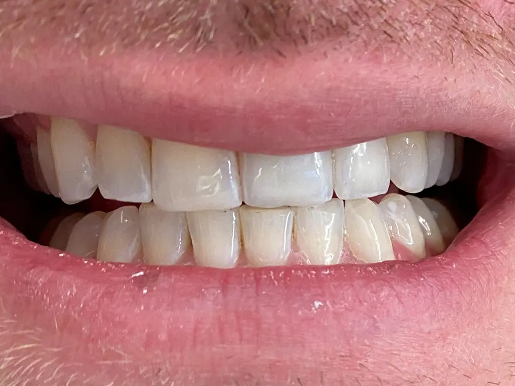 Ceramic Crown after