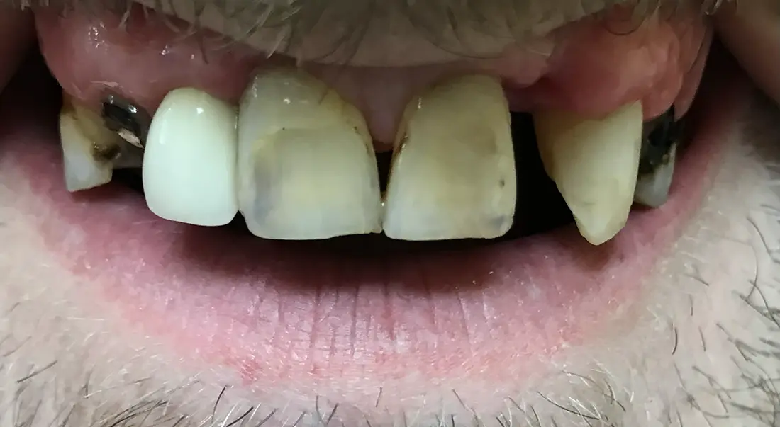 Full Arch Restoration before