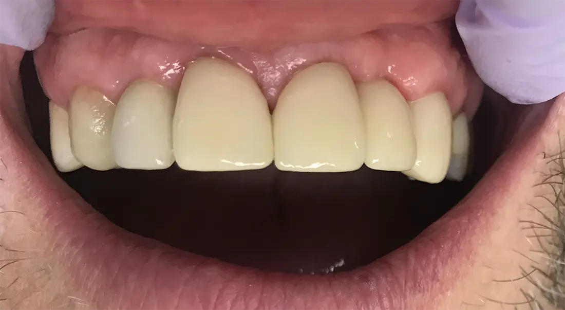 Full Arch Restoration after