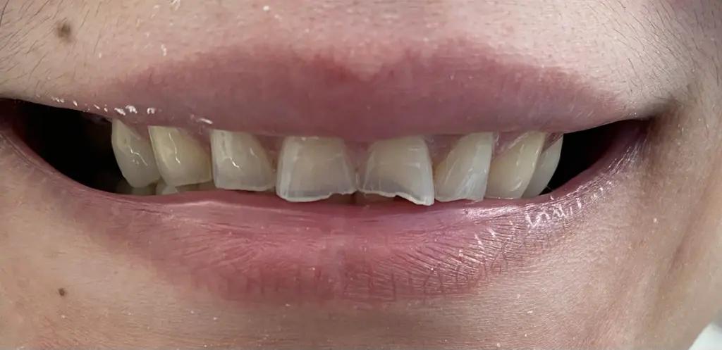 Anterior Reconstruction before