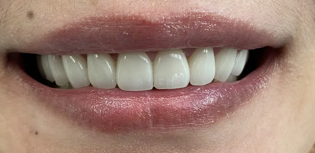 Anterior Reconstruction after
