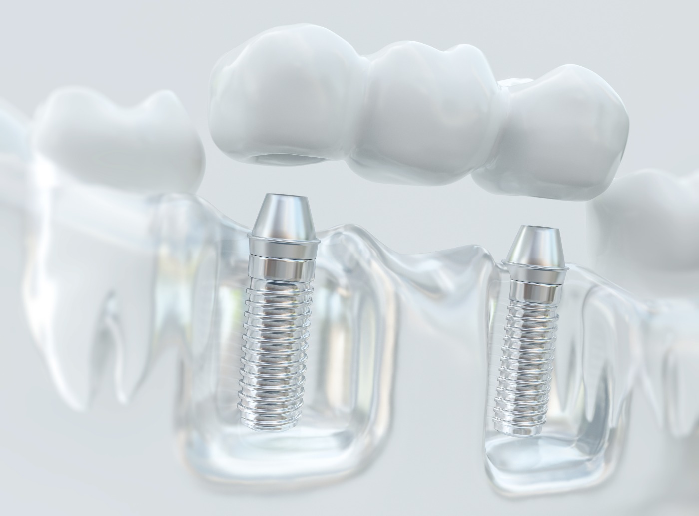 Franklin dental implants