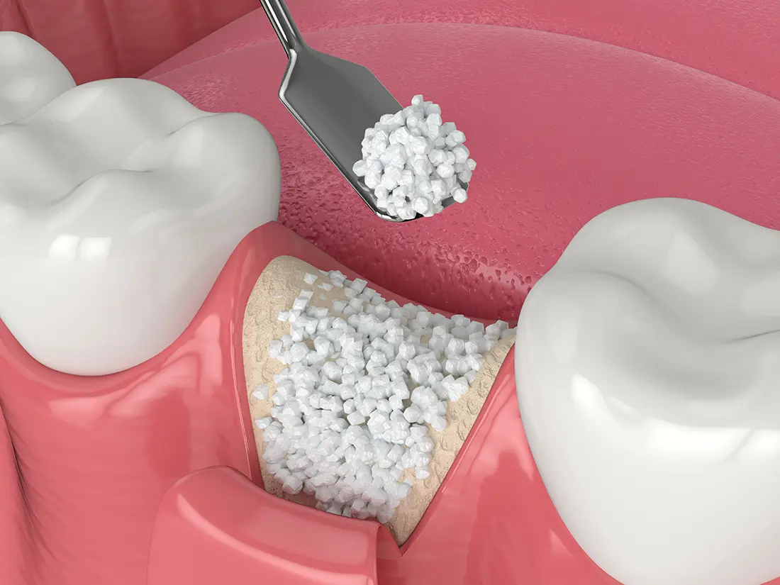 Bone Grafting & Sinus Lifts