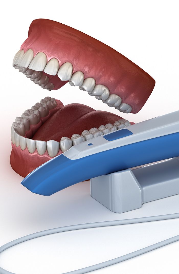 Intraoral Scanner = Mess-Free Treatment