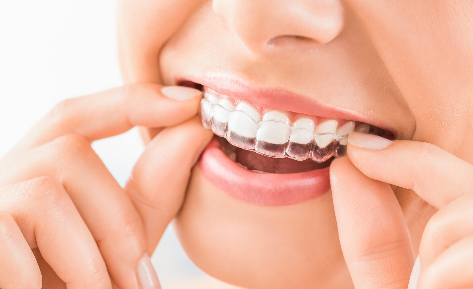 Franklin Clear Aligners