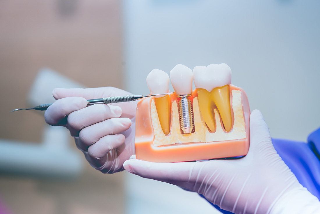 Franklin dental implants