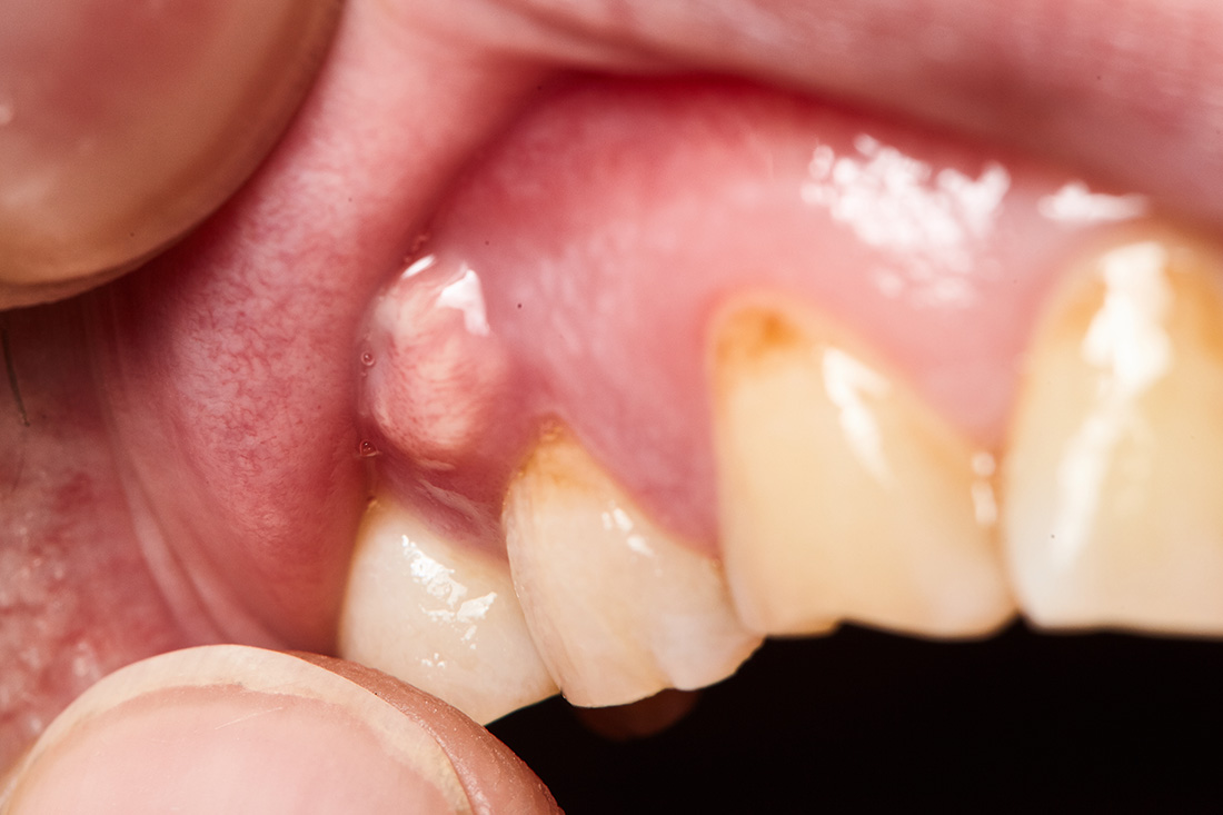 Abscess Treatment