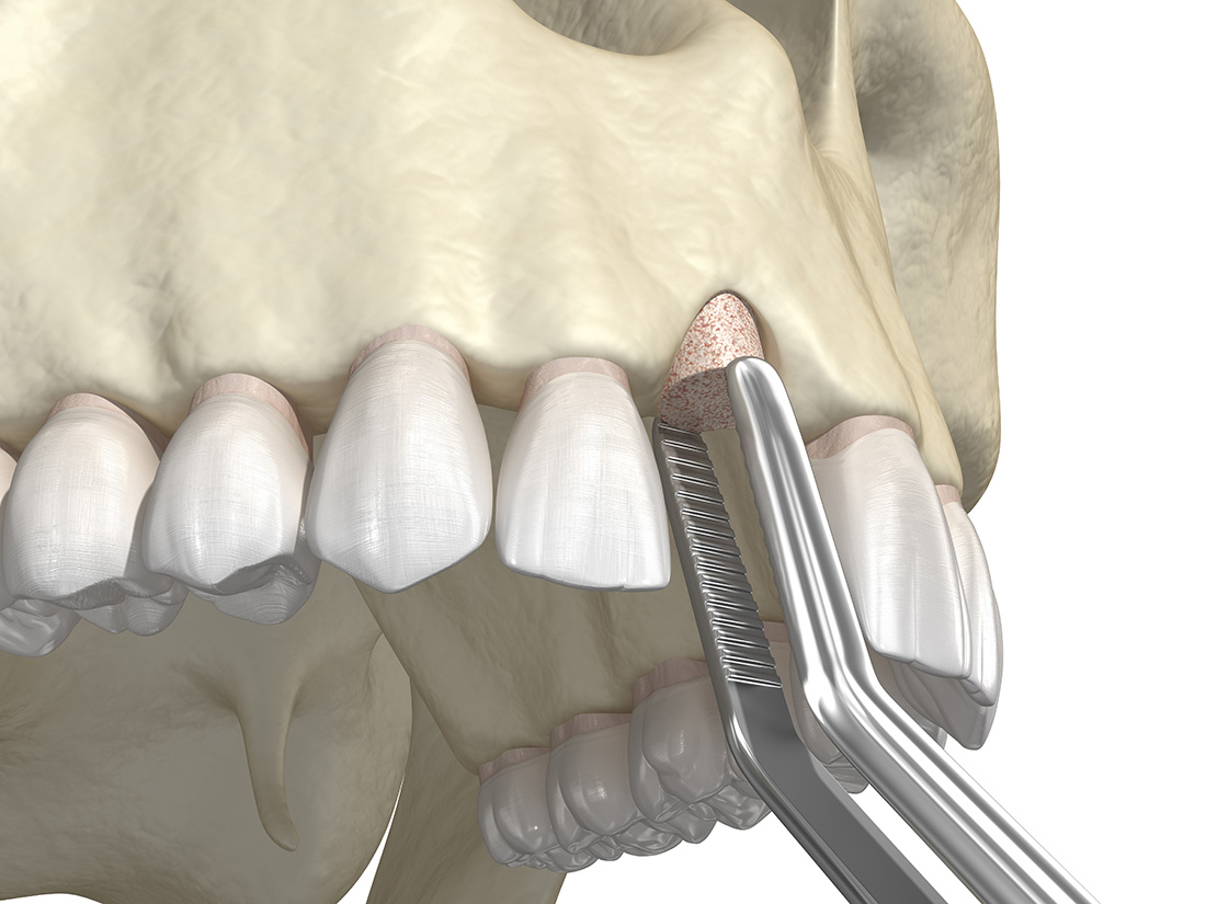 Bone Grafting