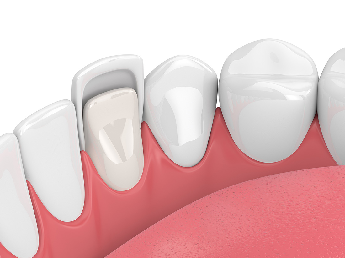 Veneers in Franklin