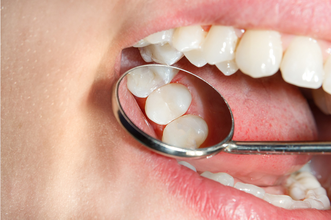 Dental Fillings