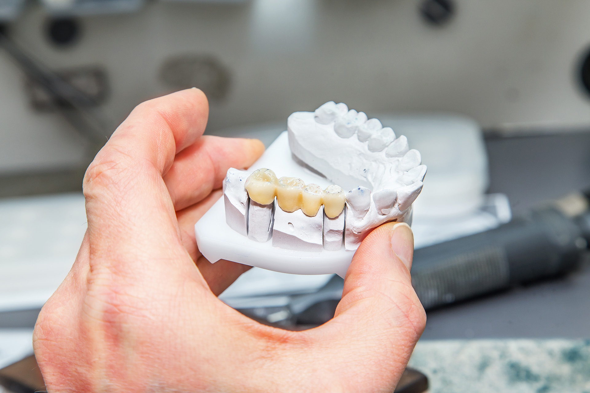 dental bridges in Franklin