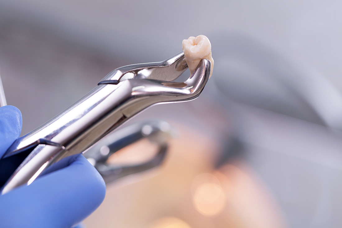 Tooth Extractions in Franklin, MA