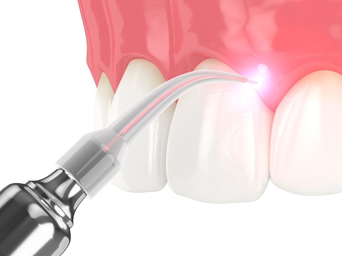 Soft-Tissue Laser Therapy