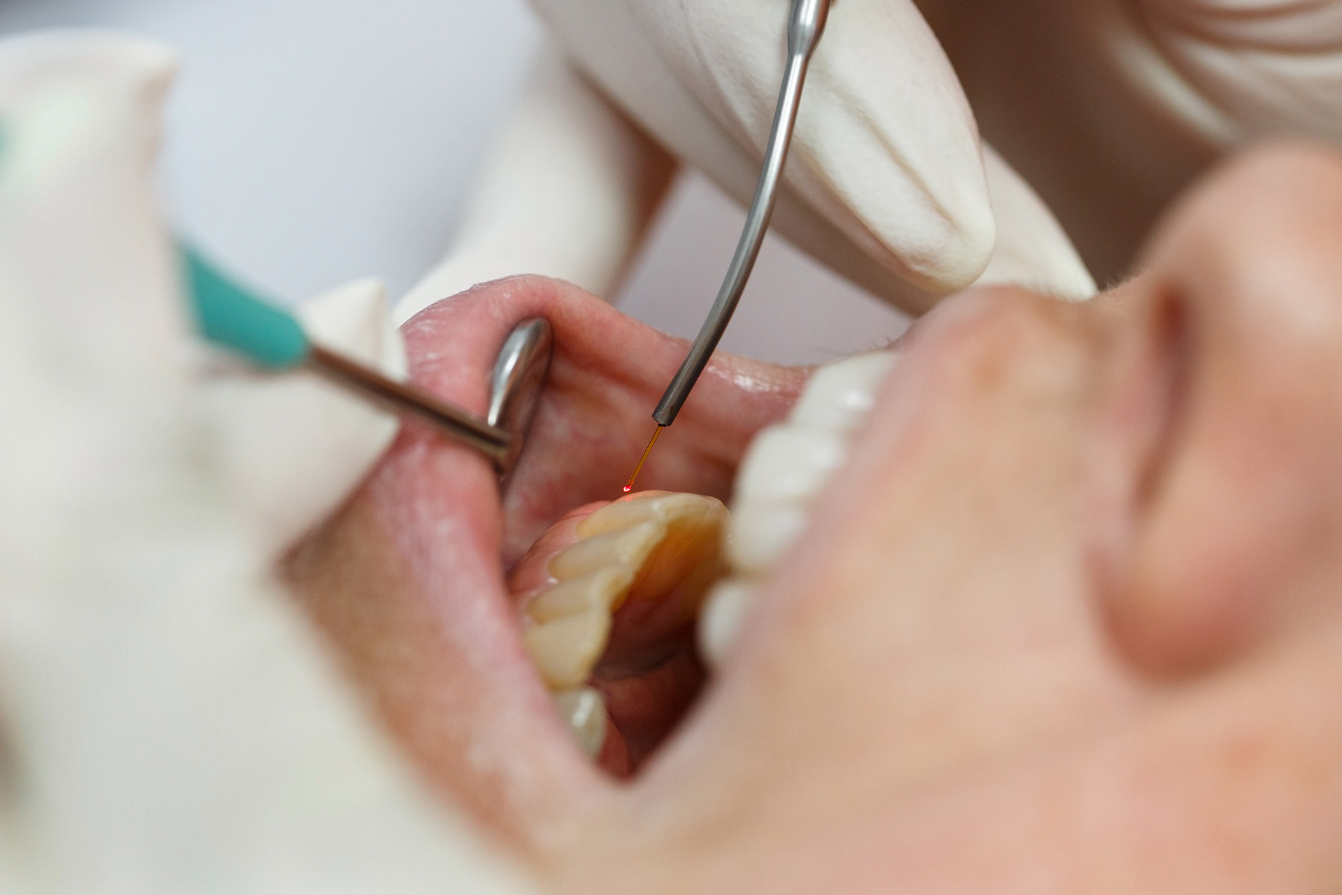 soft tissue laser therapy in Franklin