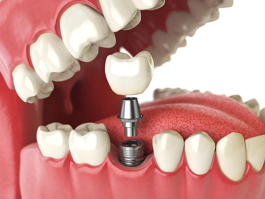 Implant Crown