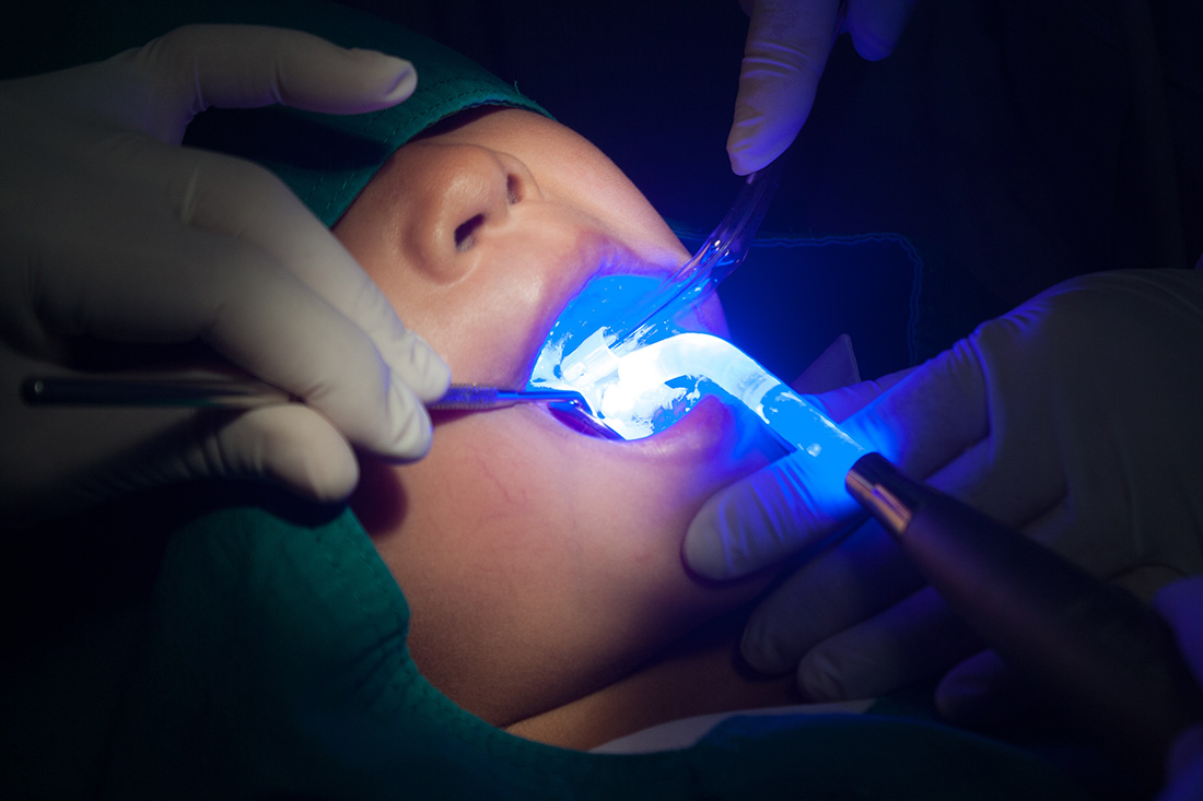 Dental Sealants