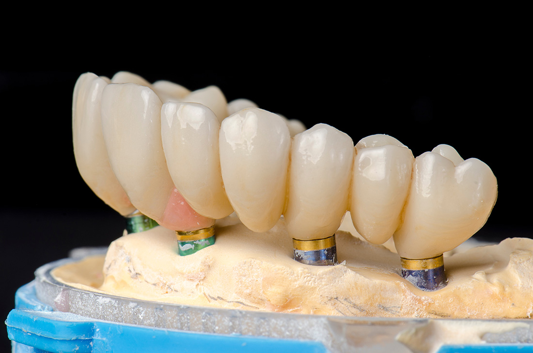 All-on-4® Implants