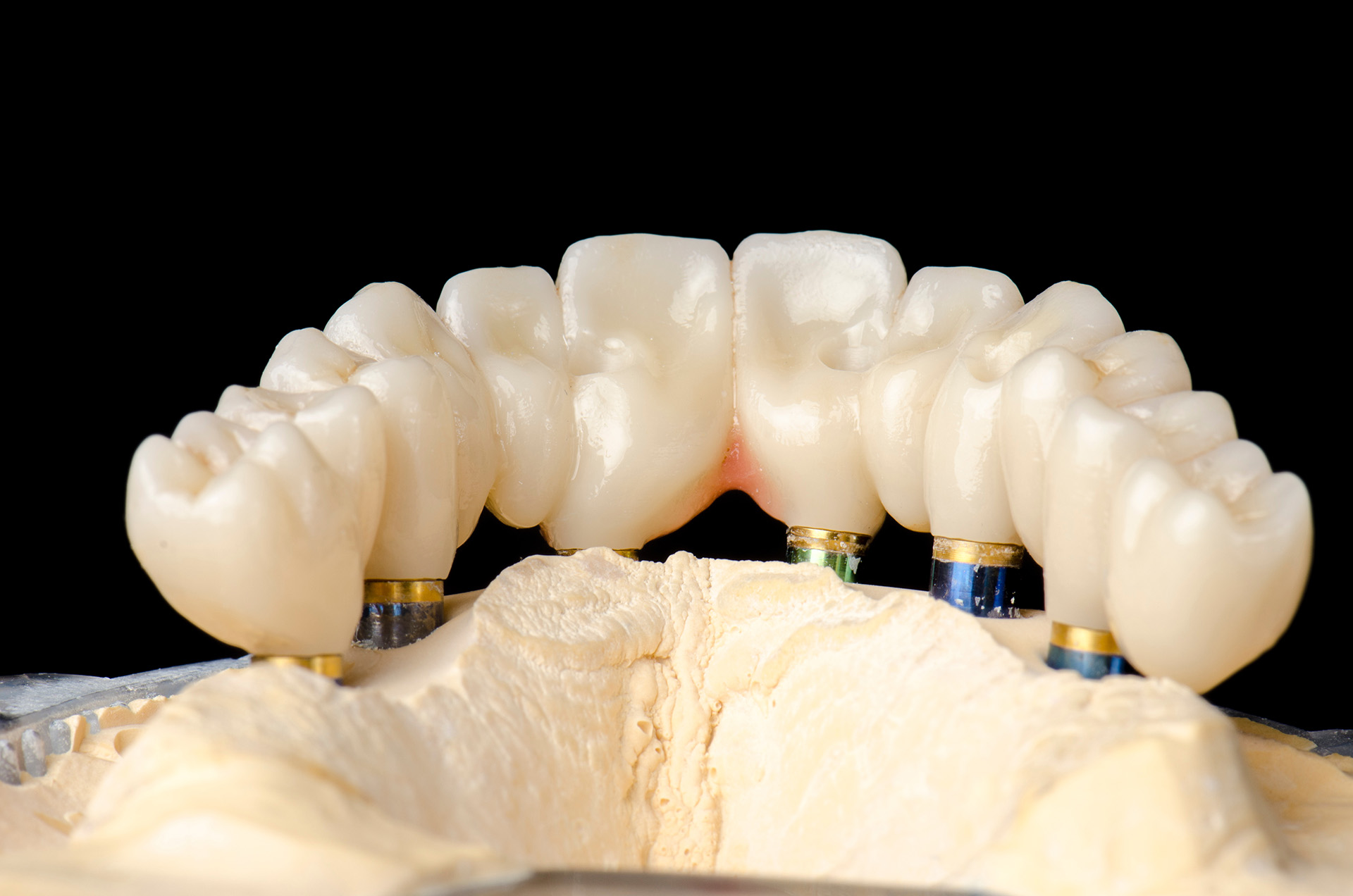 all on 4 implants in Franklin