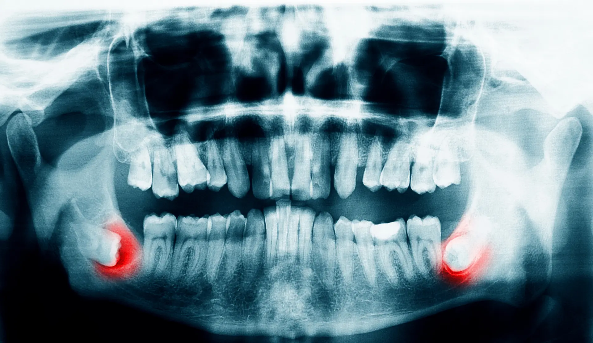 Franklin wisdom teeth removal